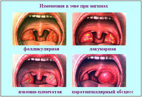 Патологическое изменение миндалин при ангине