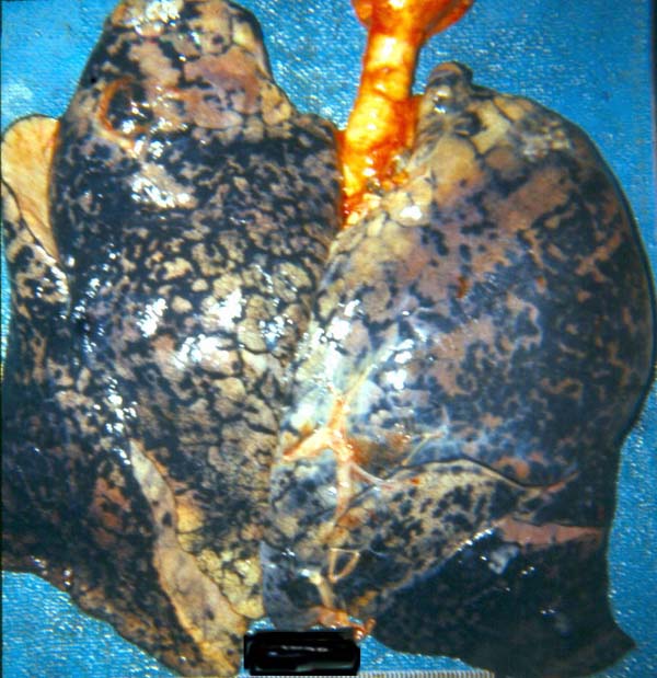 Антракоз легкого