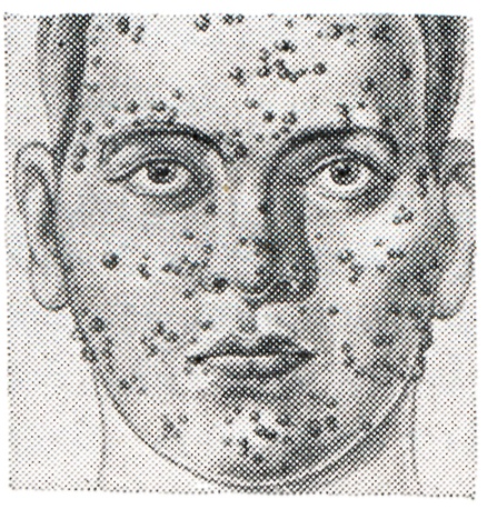 Лицо больного при бартонеллезе