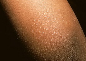 Блестящий лишай