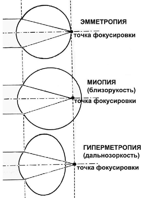 Гиперметропия - признак центральной хореоретинальной дистрофии