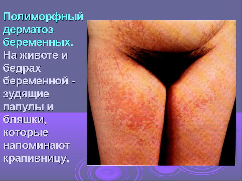 Дерматоз беременных