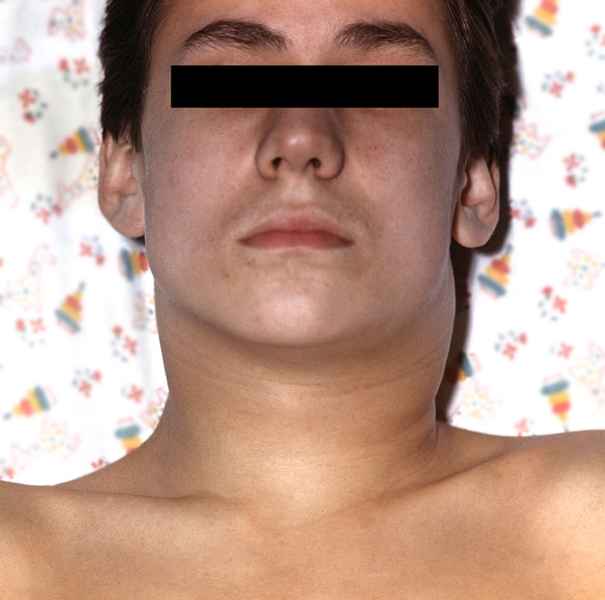 Токсическая дифтерия ротоглотки II—III степени тяжести