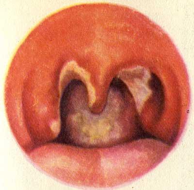 Вид зева при дифтерии Вид зева при дифтерии