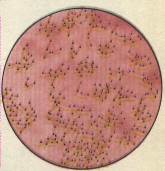 Дифтерийная палочка - возбудитель дифтерии