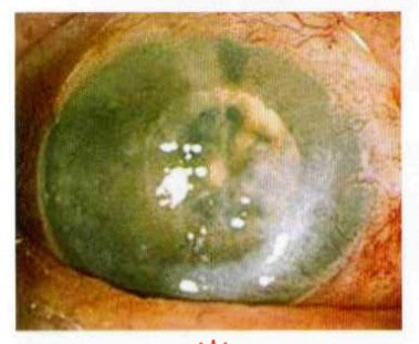 Эндотелиальная дистрофия роговицы (дистрофия Фукса)