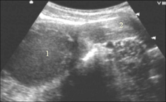 Гематометра (УЗИ-исследование)