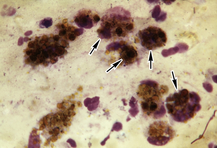 Микропрепарат бронхоальвеолярного смыва при гемосидерозе  легких