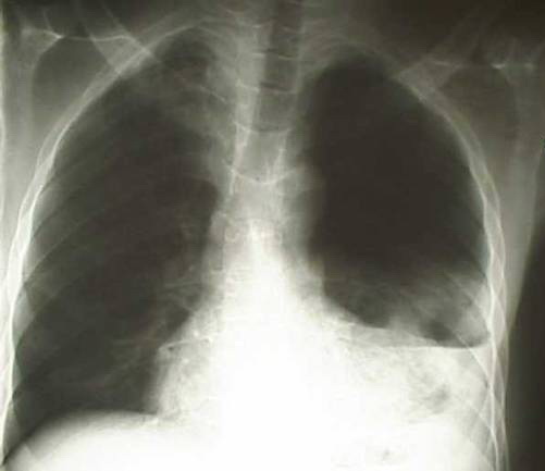 Гемоторакс на обзорной рентгенограмме