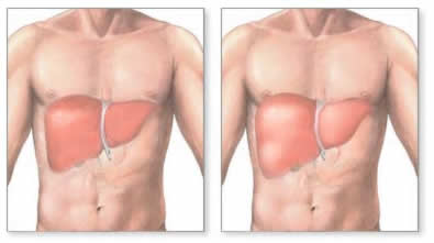 Гепатомегалия справа
