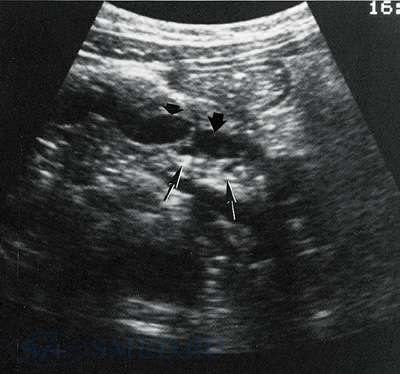 УЗИ-диагностика хронического панкреатита