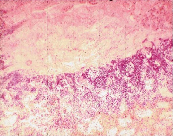 Ишемический инфаркт почки с демаркационной линией (гистологический препарат)