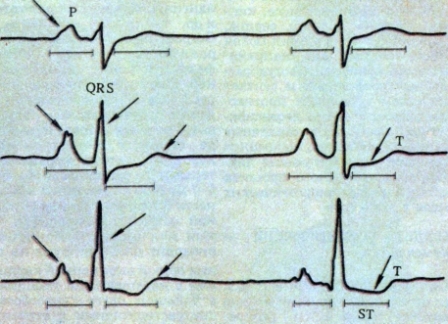 Вид ЭКГ при миокардите