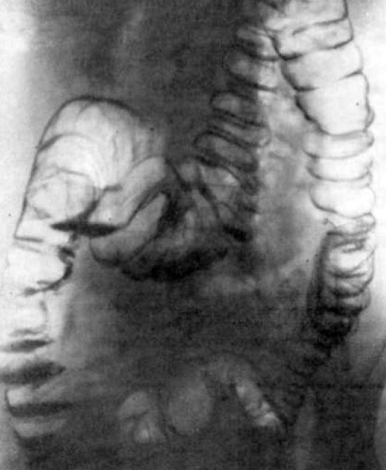 Хронический левосторонний колит при рентгенконтрастном исследовании