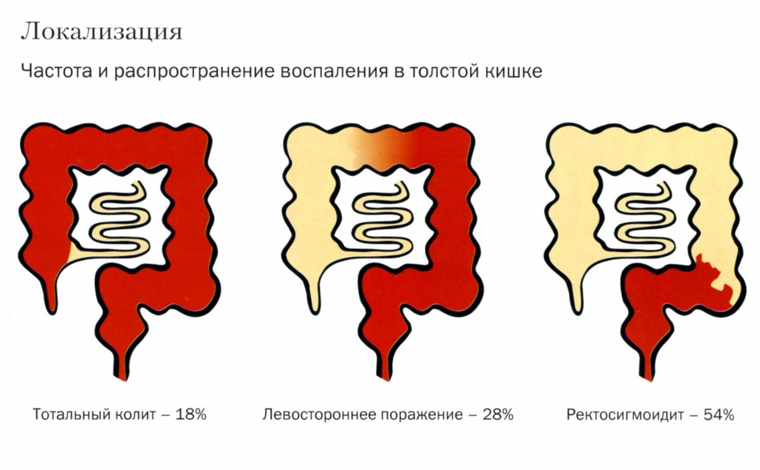 Локализация и распространенность колита