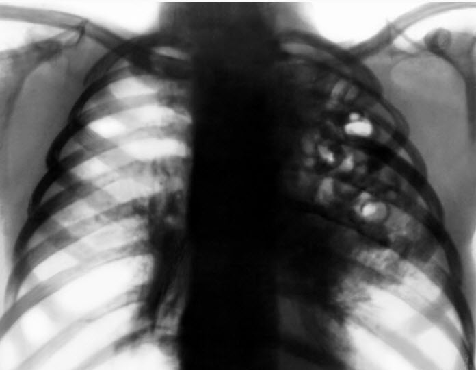 Ретгенография при легионеллезе