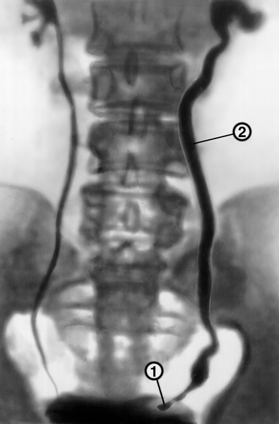 Экскреторная урограмма при мочекаменной болезни
