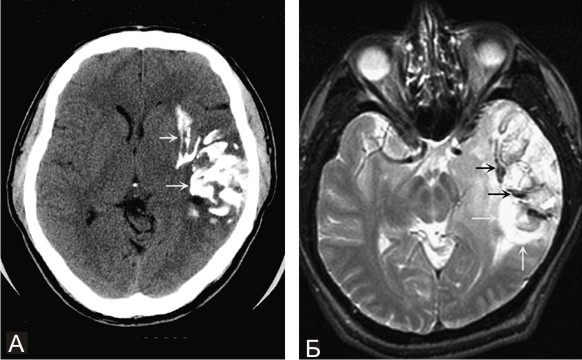 Олигодендроглиома