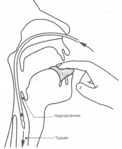 Первая помощь при острой дыхательной недостаточности