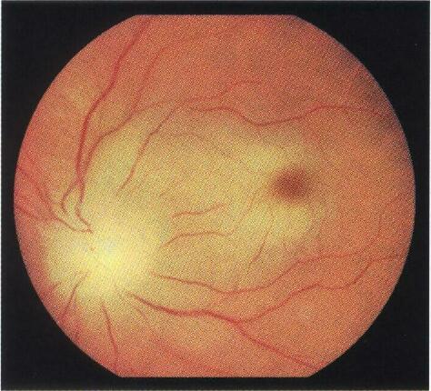 Глазное дно при острой окклюзии артерий сетчатки