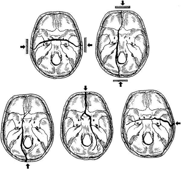 Перелом костей черепа