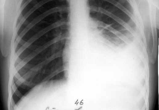Обзорный снимок. Левосторонний плеврит.  