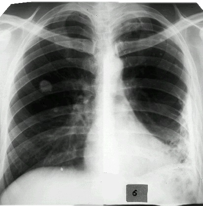 Костно-диафрагмальный плеврит. Плевральные наслоения. Остаточные изменения после перенесенного плевр