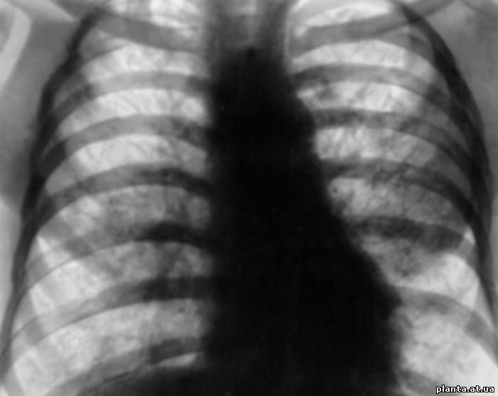 Альвеолярный протеиноз легких (рентгенограмма)