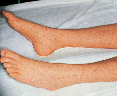 Кожные покровы больного при пятнистой лихорадке Скалистых гор