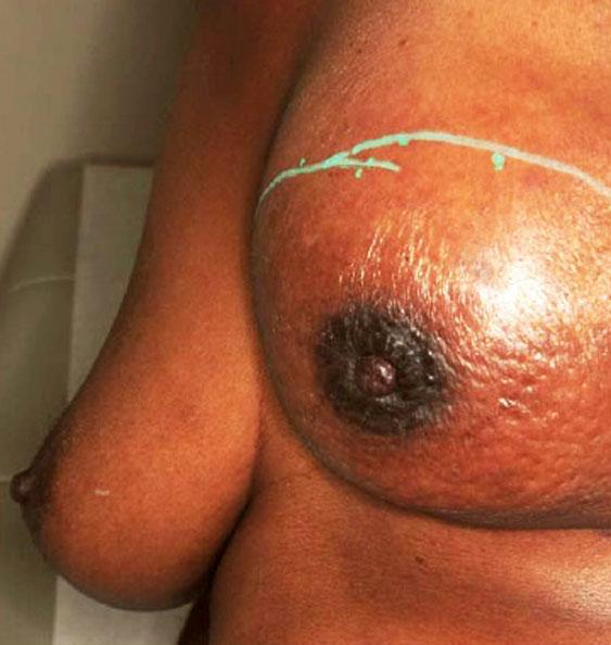 Симптом втяжения при раке молочной железы