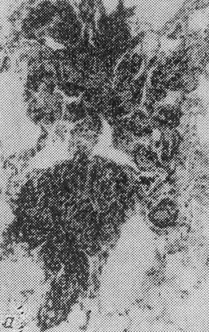 Сидероз (гистологический препарат) Сидероз (гистологический препарат)