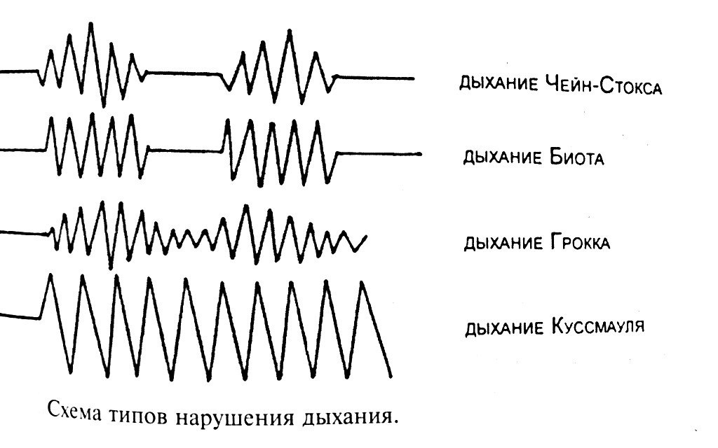 Спирограммы при патологических типах дыхания