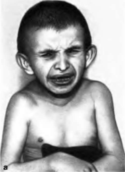 Синдром Коккейна