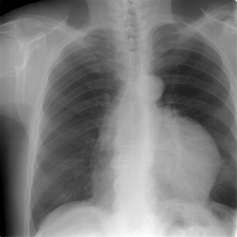 Рентгенограмма при тимоме