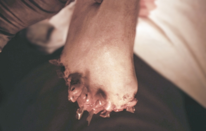 Отморожение стопы