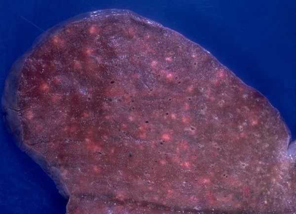 Миллиарный туберкулез легких (макропрепарат) Миллиарный туберкулез легких (макропрепарат)