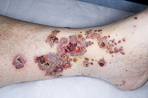 Кожная сыпь при васкулите