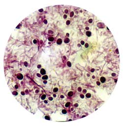 Грибковый возбудитель при легочном зигомикозе
